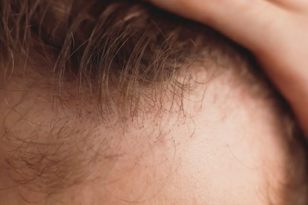 balding man is opening his forehead close up view