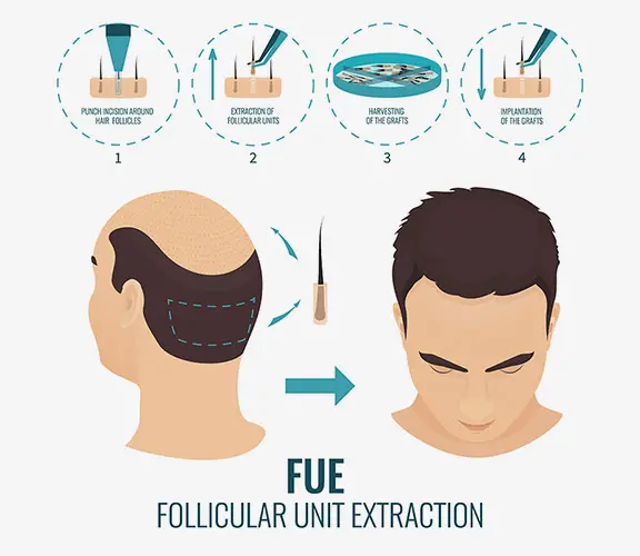 Hair transplant in Istanbul-fue-technique-hair-transplant-1